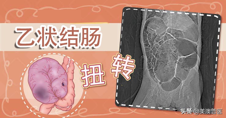 乙状结肠扭转原因,乙状结肠扭转病例