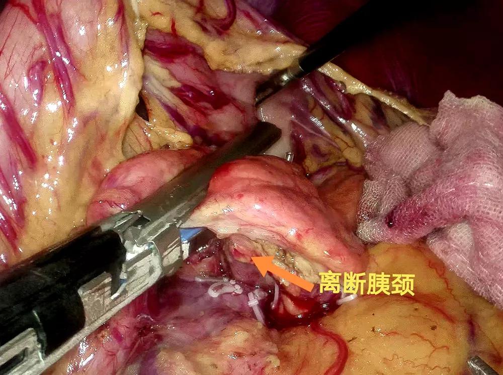 腹腔镜胰腺中段切除术的现状,腹腔镜下胰体尾部切除手术步骤