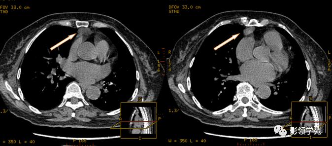 纵隔和肾上腺恶性肿瘤,纵隔性肿瘤位置图