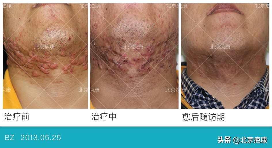 怎么判断瘢痕疙瘩是否复发,瘢痕疙瘩如何彻底治愈