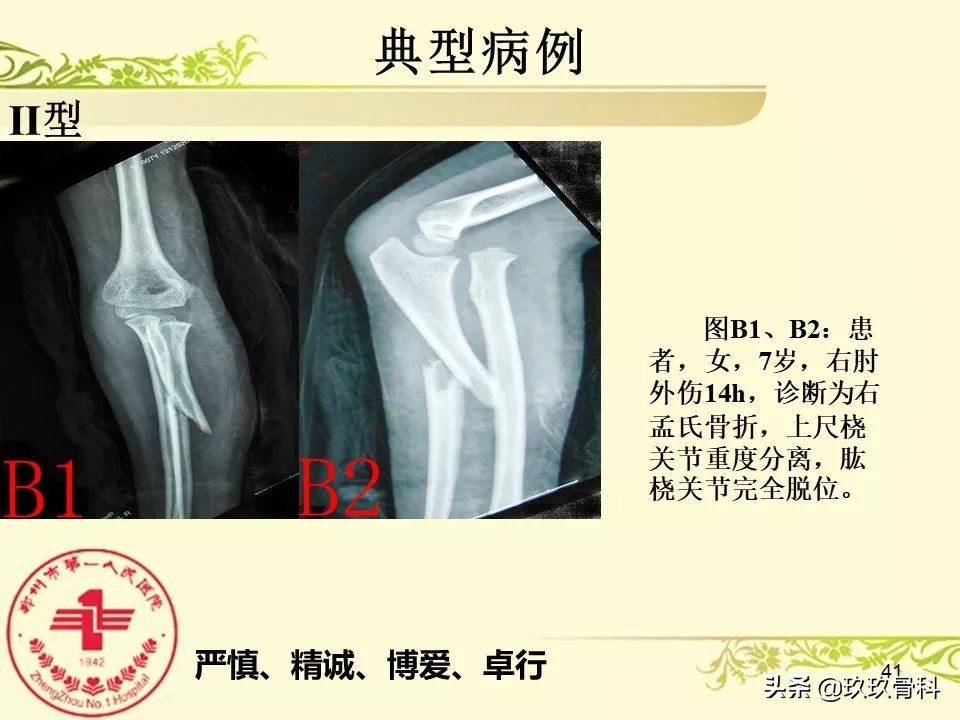 孟氏骨折功能训练多久能恢复正常,孟氏骨折中医能治吗