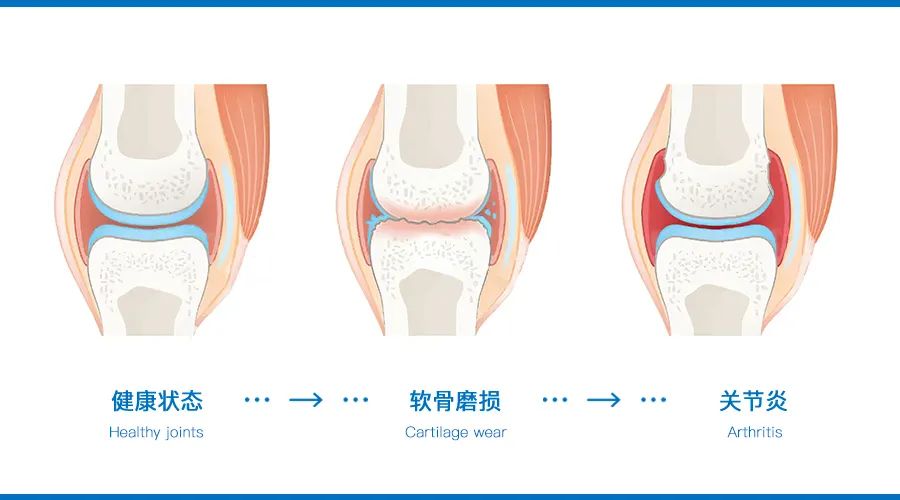 下雨天膝关节疼痛是怎么回事,下雨天膝关节肿大硬