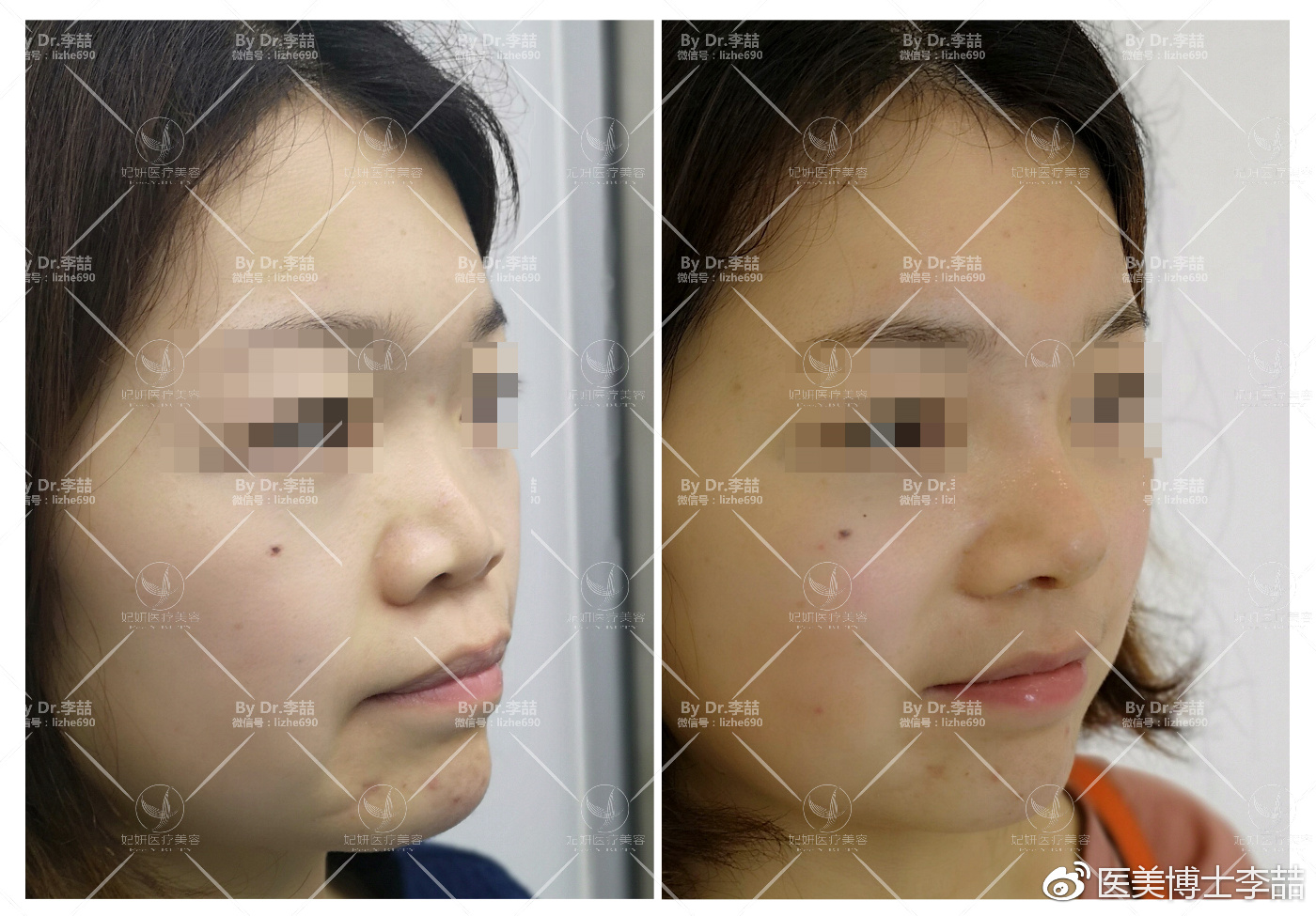 先天性鼻缺损和畸形的修复,先天性鼻中隔缺损