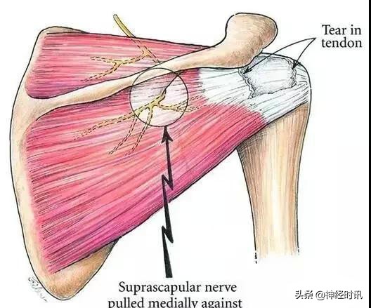 周围神经卡压解剖与分析,腓浅神经卡压解剖视频