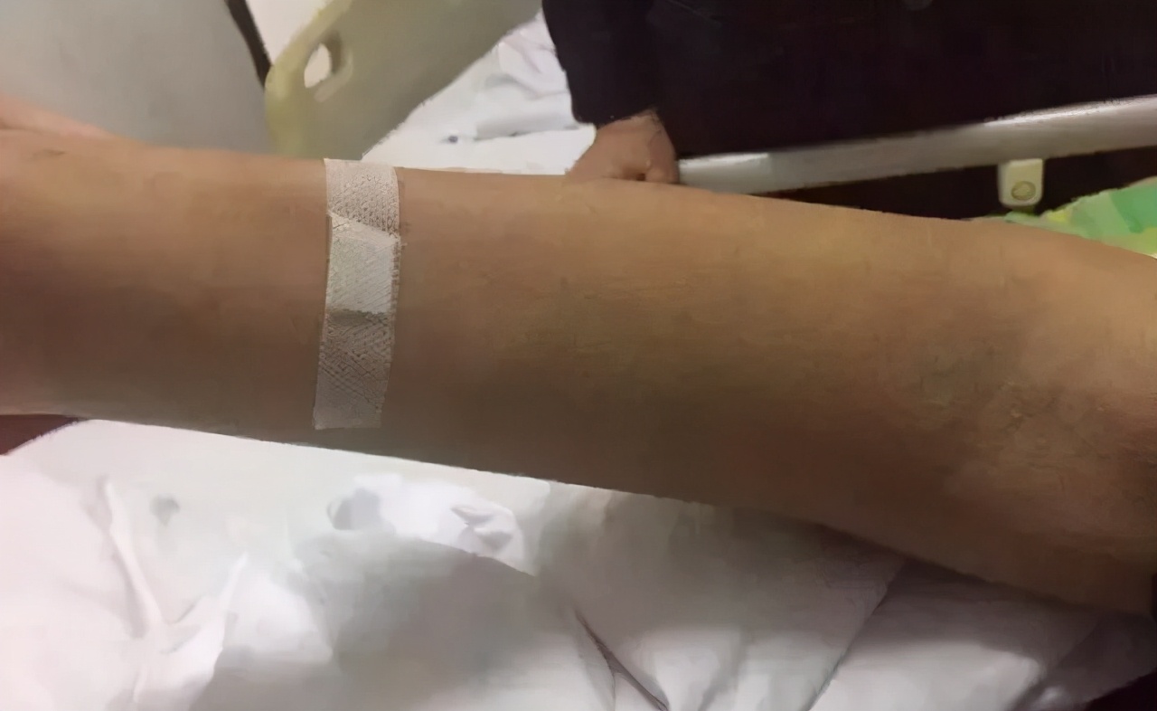 70岁老人化疗后手和脚肿正常吗,老人化疗之后身体越来越差