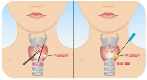 发现甲状腺结节要不要治,甲状腺结节手术同时切除淋巴结