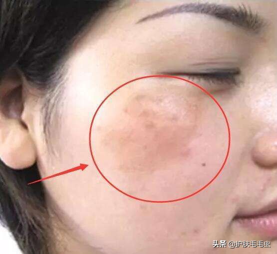 脸上长斑是什么原因怎样能调理好,什么原因导致脸上长斑要怎么治疗
