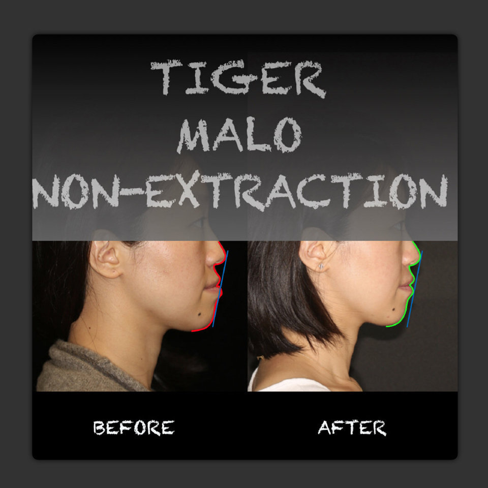 南京隐适美认证医师,南京隐适美价格