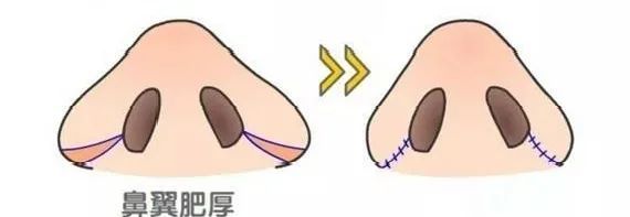 鼻翼缩小和鼻头缩小需要全麻吗,鼻头缩小和鼻翼缩小有什么区别