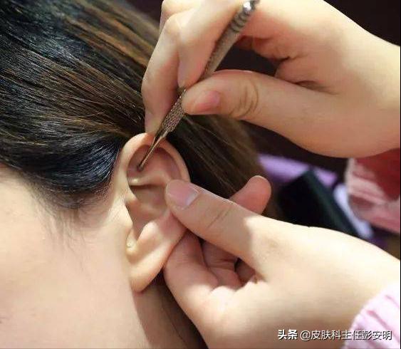 给耳朵扎针放血,耳朵上扎针放血