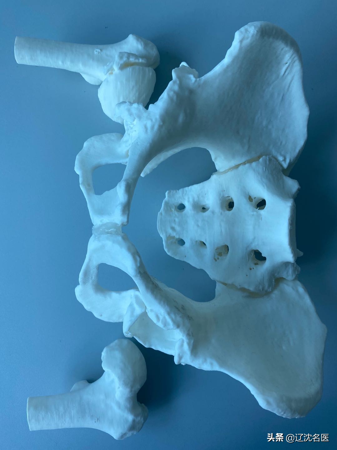 股骨头坏死置换后遗症,股骨头坏死吃止痛片有用吗