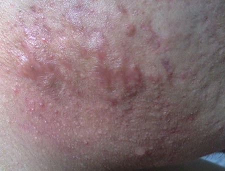 长痘痘的症状有哪些呢,长痘痘的原因及解决方法