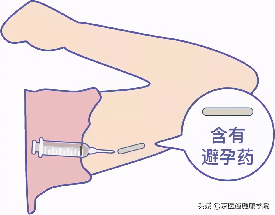 古代避孕最有效的方法,中医紧急避孕补救法大全