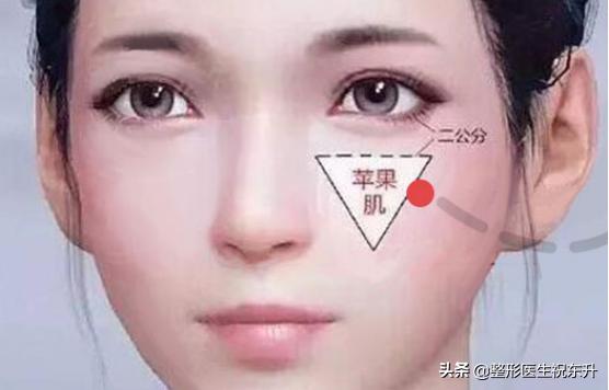 自体脂肪丰苹果肌的效果如何,填充苹果肌用自体脂肪还是玻尿酸