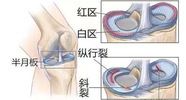韦德几岁半月板摘除,韦德大学时为什么摘除半月板