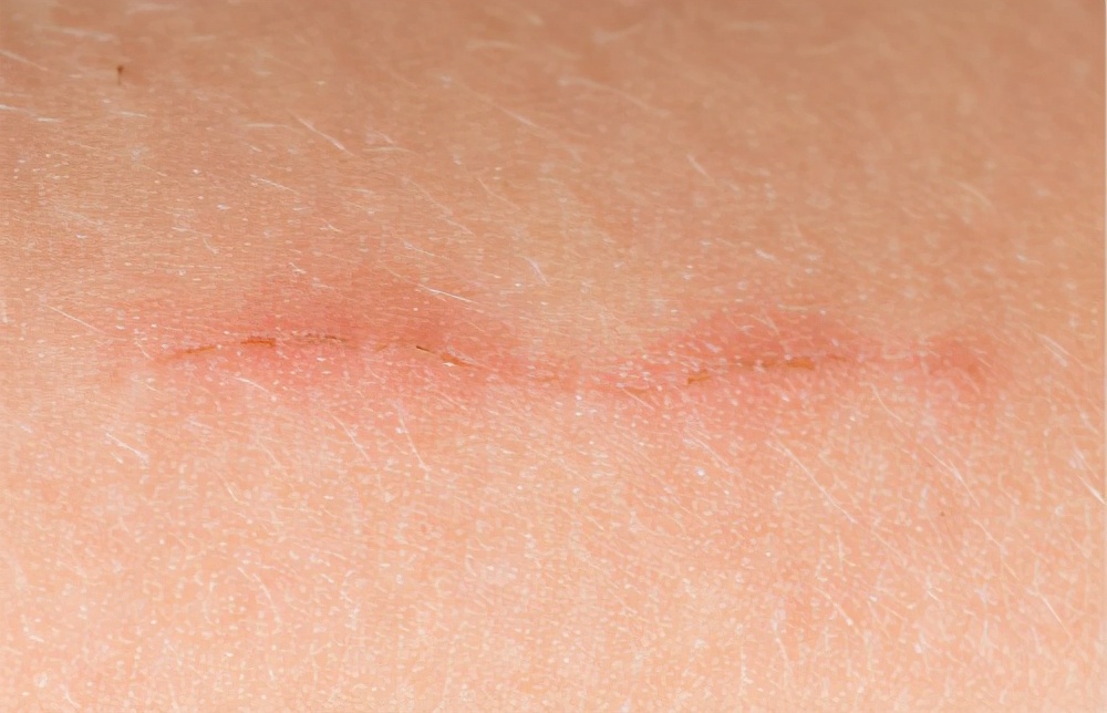 疤痕炎症怎么办才能彻底消除,疤痕问题解答