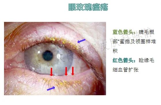过敏脸上身上全是红痘痘,脸红就是玫瑰痤疮吗