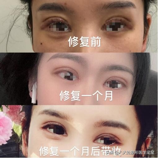 平行式双眼皮变成普通窄双眼皮了,悲伤蛙双眼皮图片