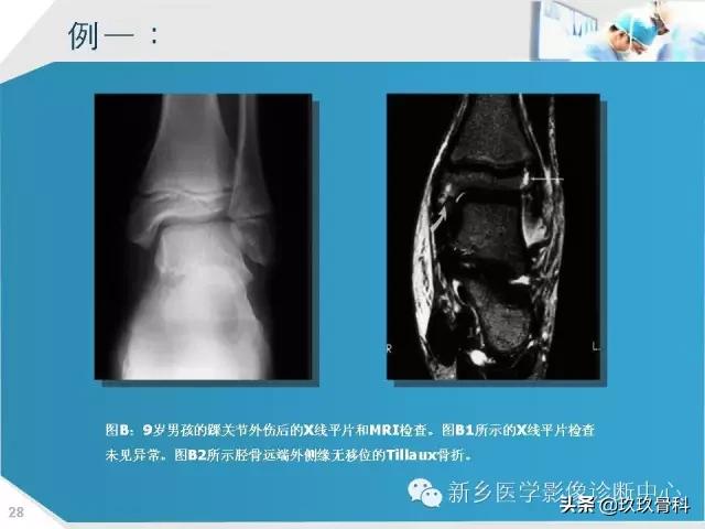 骨骺损伤x线表现,骨骺损伤磁共振表现