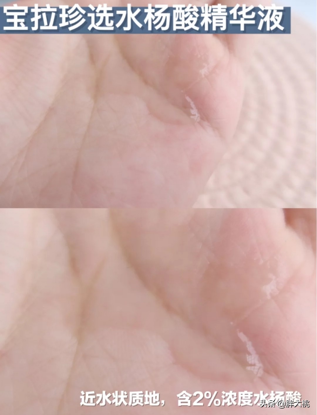 黑头闭口刷水杨酸好还是果酸好,毛孔黑头闭口怎么刷酸