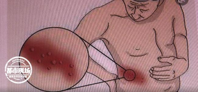 每年夏天左脚长水泡怎么回事,左腿突然长几个水泡怎么治疗