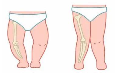 衡量两岁宝宝x型腿的标准是什么,如何判断小孩是不是O型腿