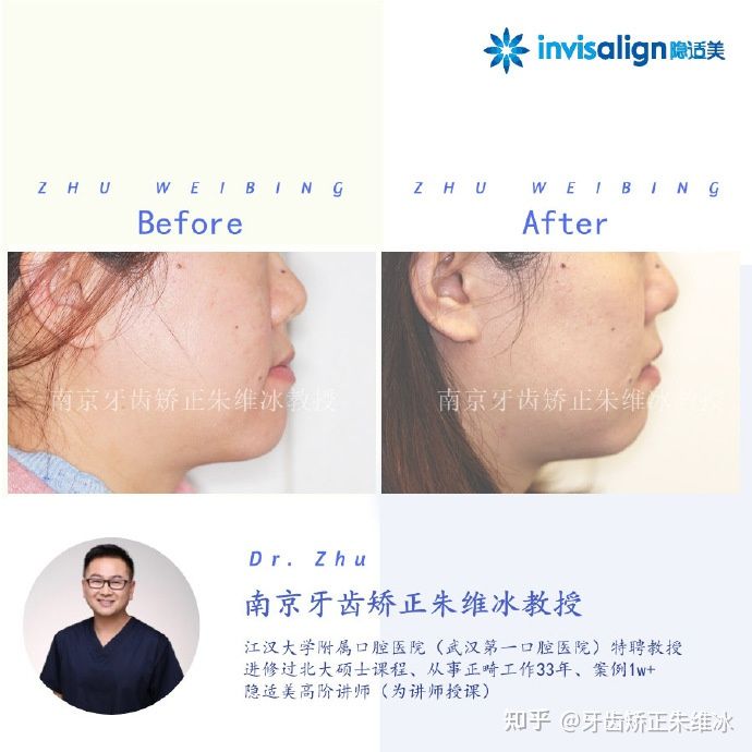 南京牙齿矫正骨性嘴凸案例,郑州牙齿矫正会让脸型更好看吗