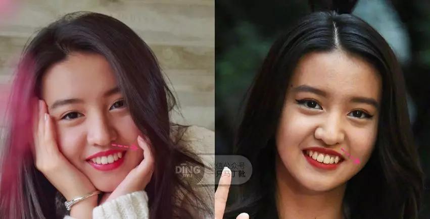 戴牙套凸嘴怎么化妆,凸嘴整牙削骨吗