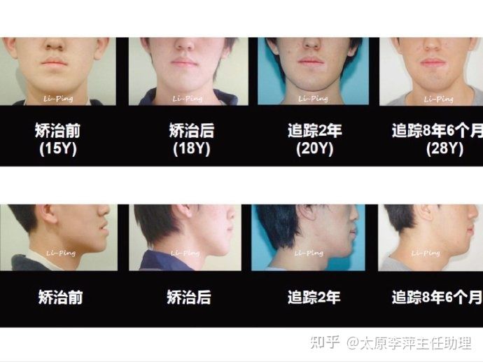 太原市牙齿正畸,太原市口腔正畸