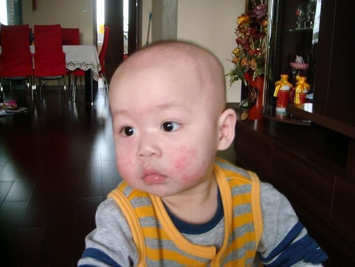 幼儿湿疹注意事项和饮食,面部湿疹饮食要注意什么