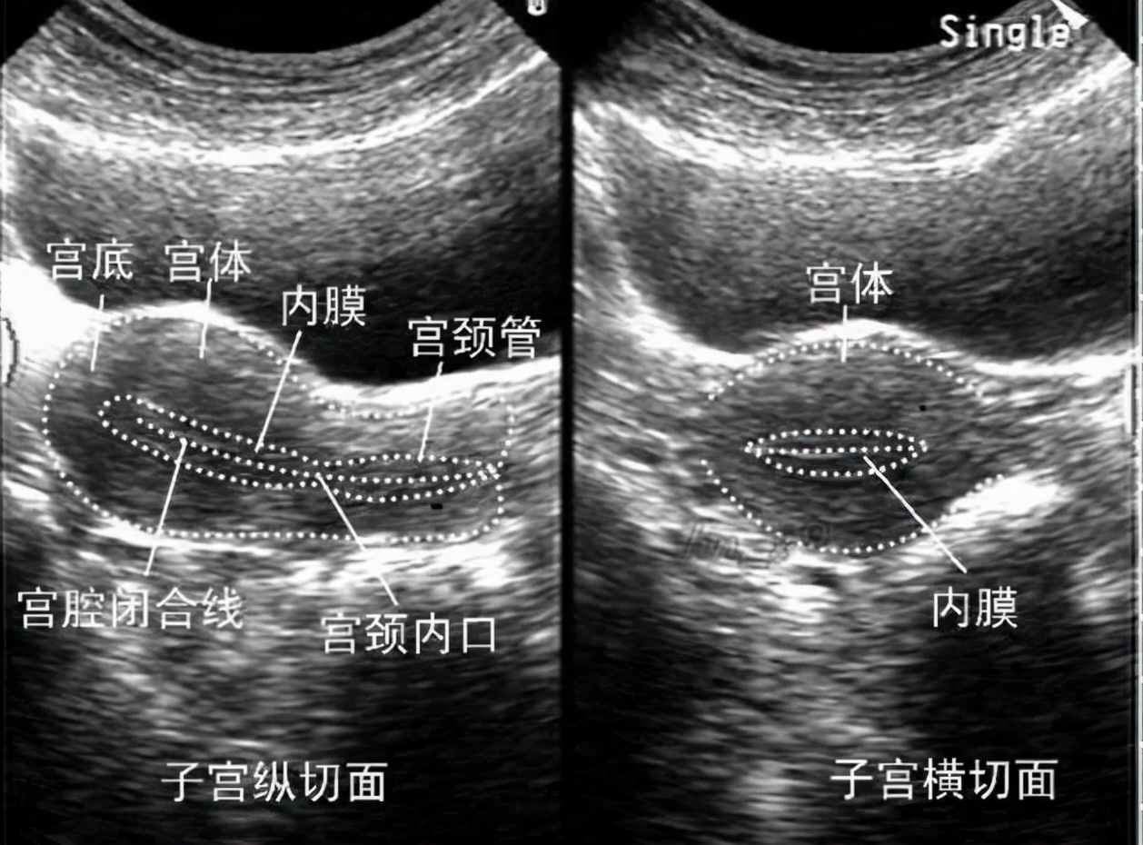 子宫内膜薄可以试管吗,子宫内膜薄怎么办能做试管吗