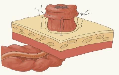 结肠癌术后引流管疼痛怎么办,结肠癌术后伤口流脓怎么办