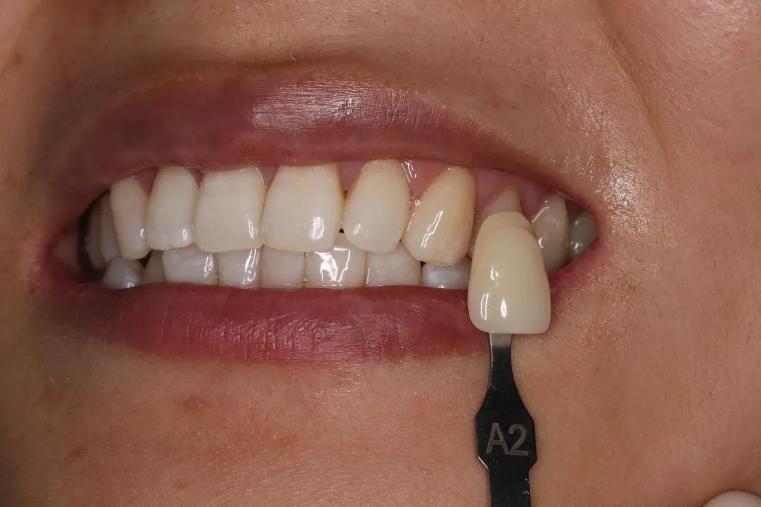 牙齿美白这个行业靠谱吗,柠檬美白牙齿靠谱吗