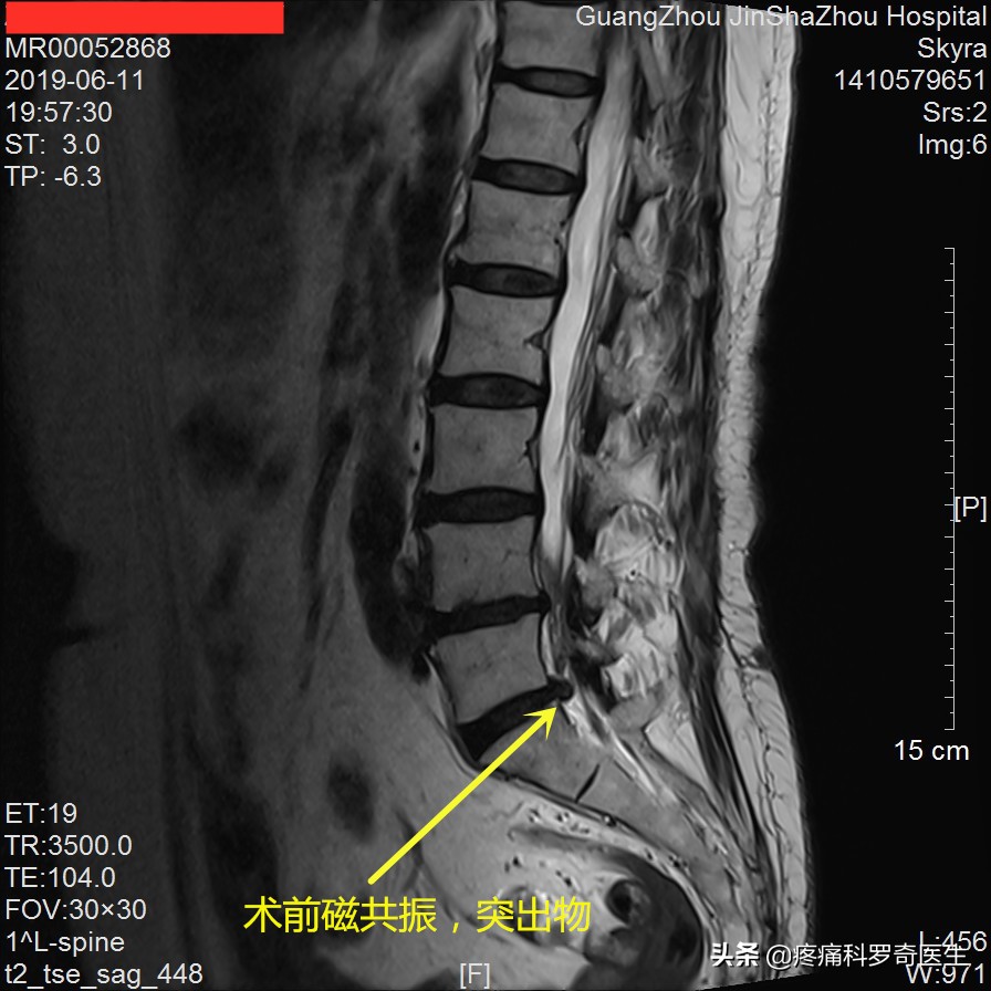 腰椎间盘突出神经根粘连能自愈吗,腰椎微创手术后神经根粘连怎么办