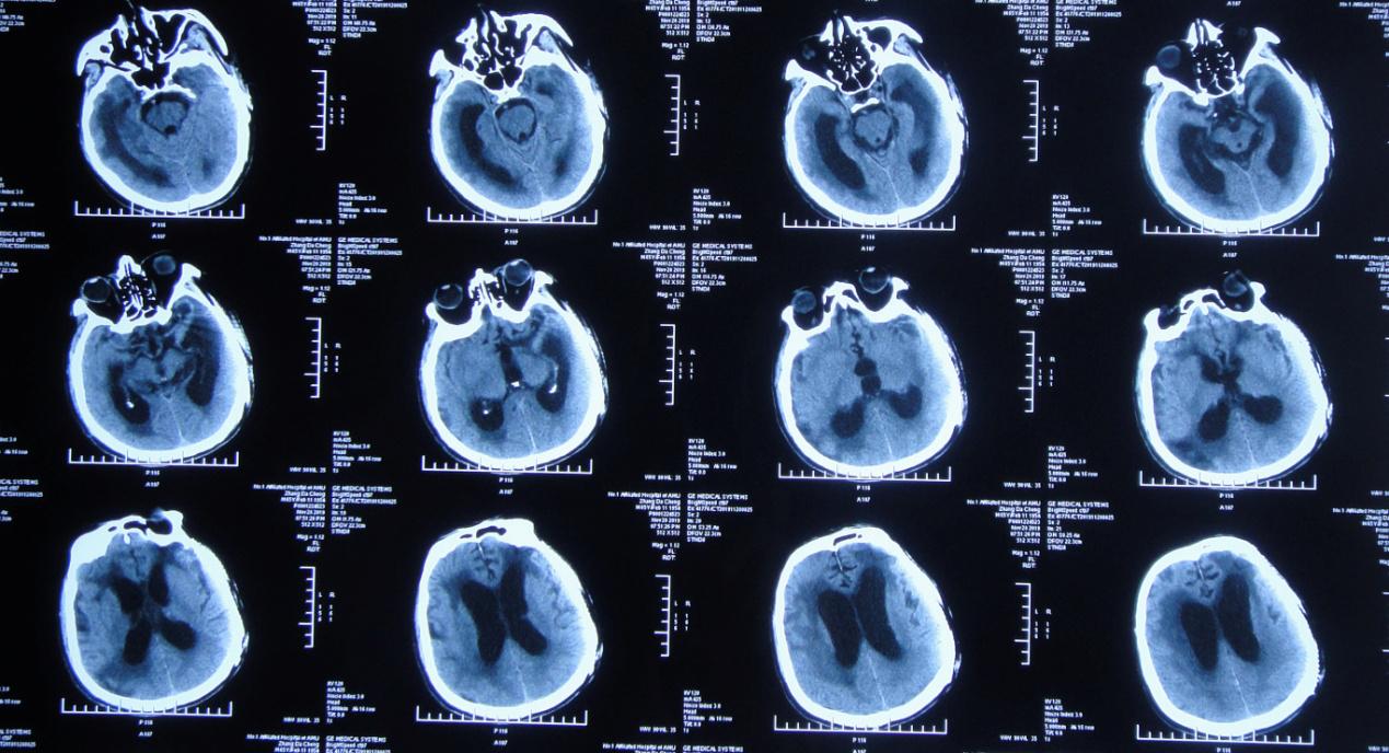 颅脑外伤术后脑积水,脑外伤脑积水颅骨缺失