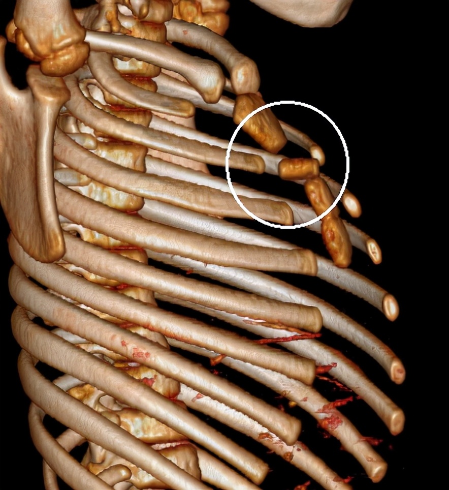 多发性肋骨骨折引发胸廓畸形矫正,股骨下端粉碎性骨折三维重建
