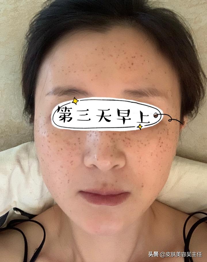 蜂巢皮秒英诺小棕瓶,脸上有斑的可以用英诺小棕瓶吗