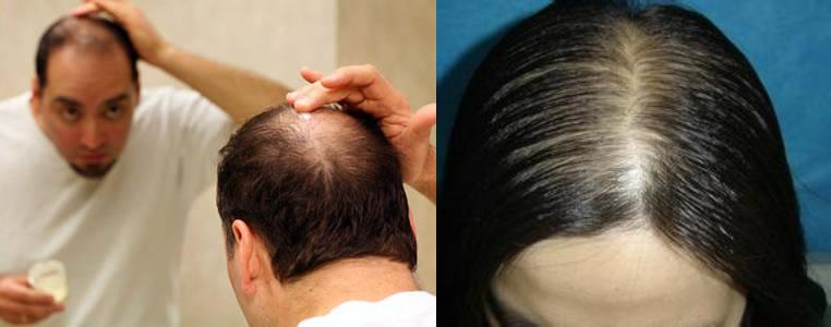 小宝宝脱发严重怎么办,拯救脱发小宝贝