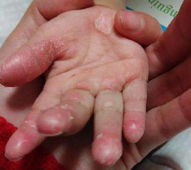 孩子手老是反复脱皮,小孩老是手脱皮什么引起的