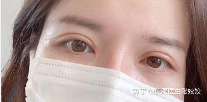 埋线双眼皮两边不对称怎么办,埋线双眼皮不对称修复方法