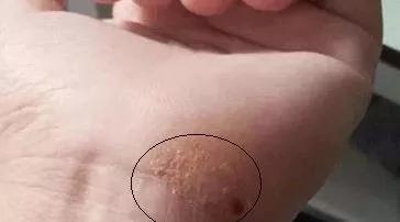 汗疱疹到夏天手脚起小水泡很痒,夏季汗疱疹是什么原因