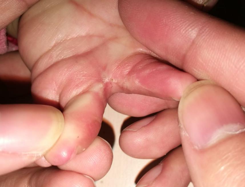 并指畸形免植皮案例,并指畸形