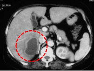 举例科普|介入能治疗哪些疾病?