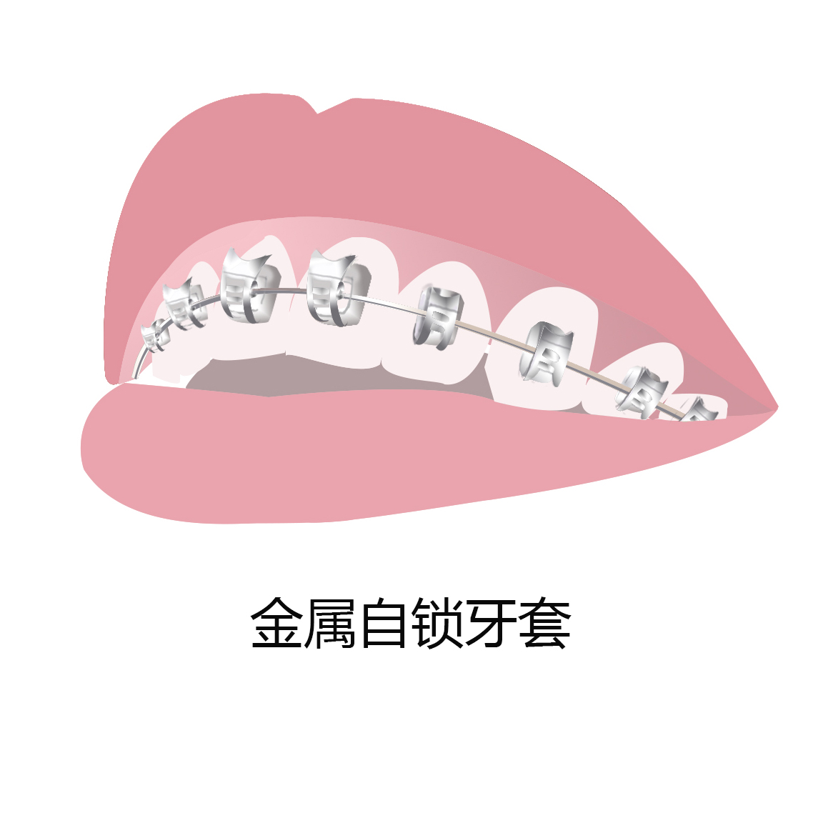 现在牙套有几种哪种好,牙套哪种最好