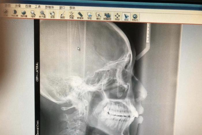 牙套隐形日记,牙套日记正颌