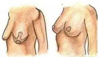 什么时候乳房开始衰老,乳房衰老的表现