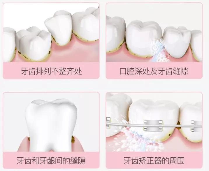 小米冲牙器伤牙,小米有品冲牙器头