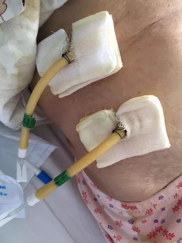 引流伤口有渗液流出怎样处理,术后20天引流液还很多怎么办