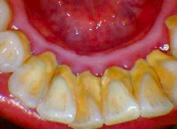 牙周炎导致牙齿脱落能做全瓷牙吗,牙周炎导致牙齿脱落会得口腔癌吗