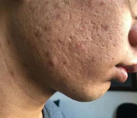 面部生疮后的瘢痕怎么办,疱疹后遗症怎么治